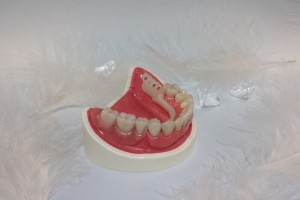Herausnehmbarer Zahnersatz