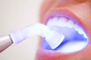 Zahnaufhellung mit Laser