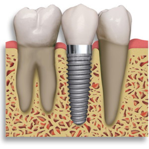 fogászat fogpótlás fogorvos